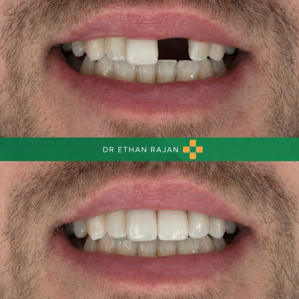 Dental implants before and after result