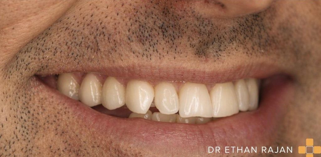 After composite bonding treatment with balanced, natural-looking smile restoration