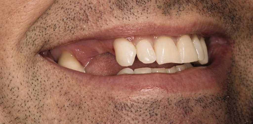 Before composite bonding treatment showing uneven and worn front teeth