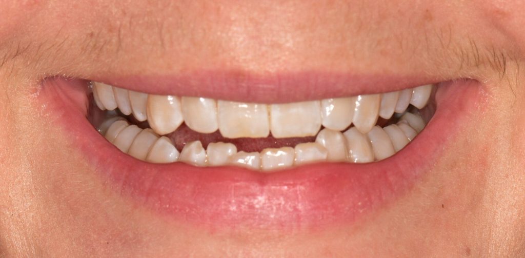 Composite bonding before treatment showing chipped and uneven front teeth