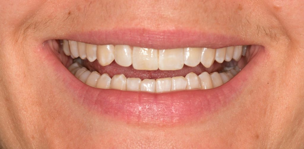 Composite bonding after treatment with straighter, natural-looking teeth