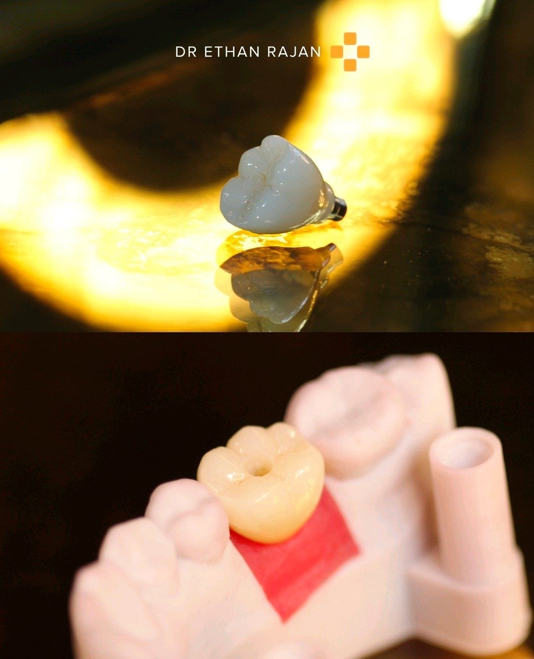 Dental implants before and after result