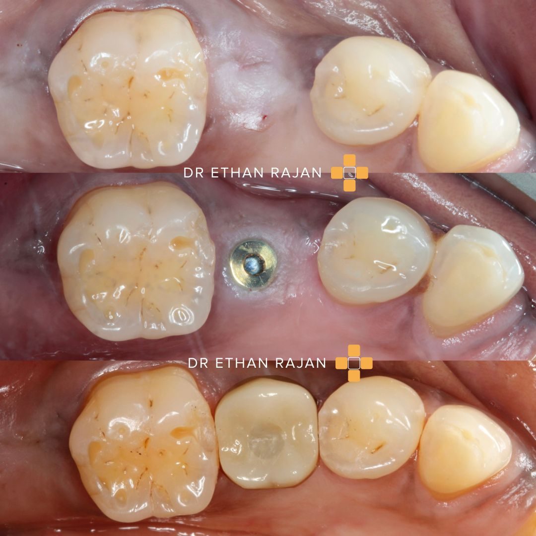 Dental implants before and after result