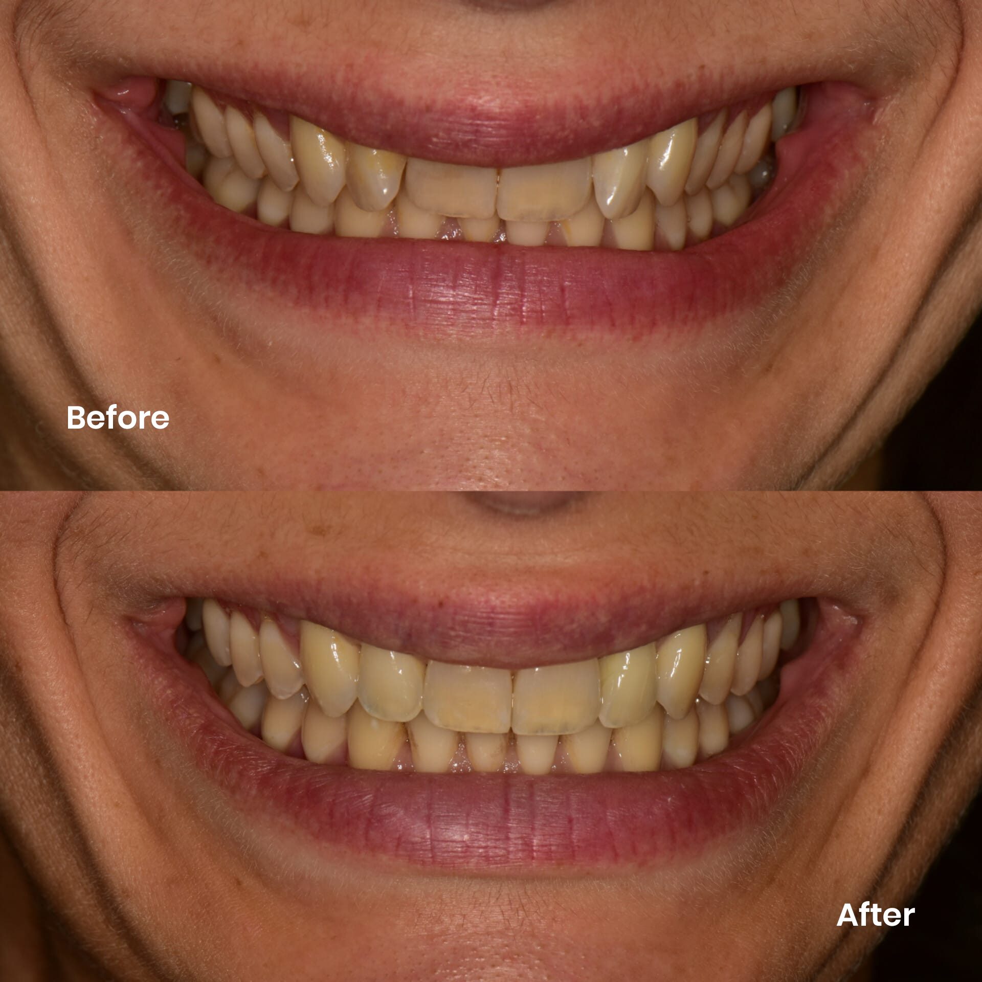 Invisalign result