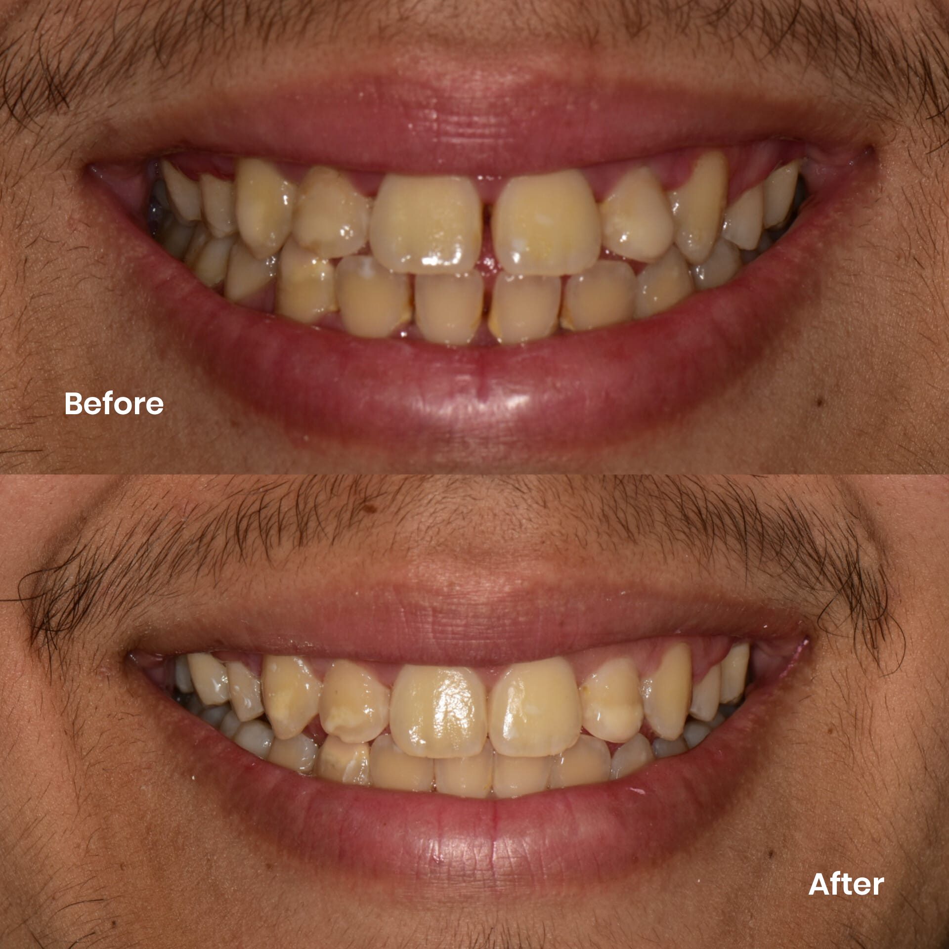 Invisalign result